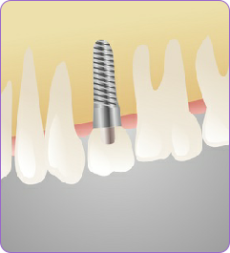 Dental Implants In Didcot Oxfordshire